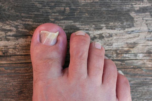 damaged-toenail-top-view (1)